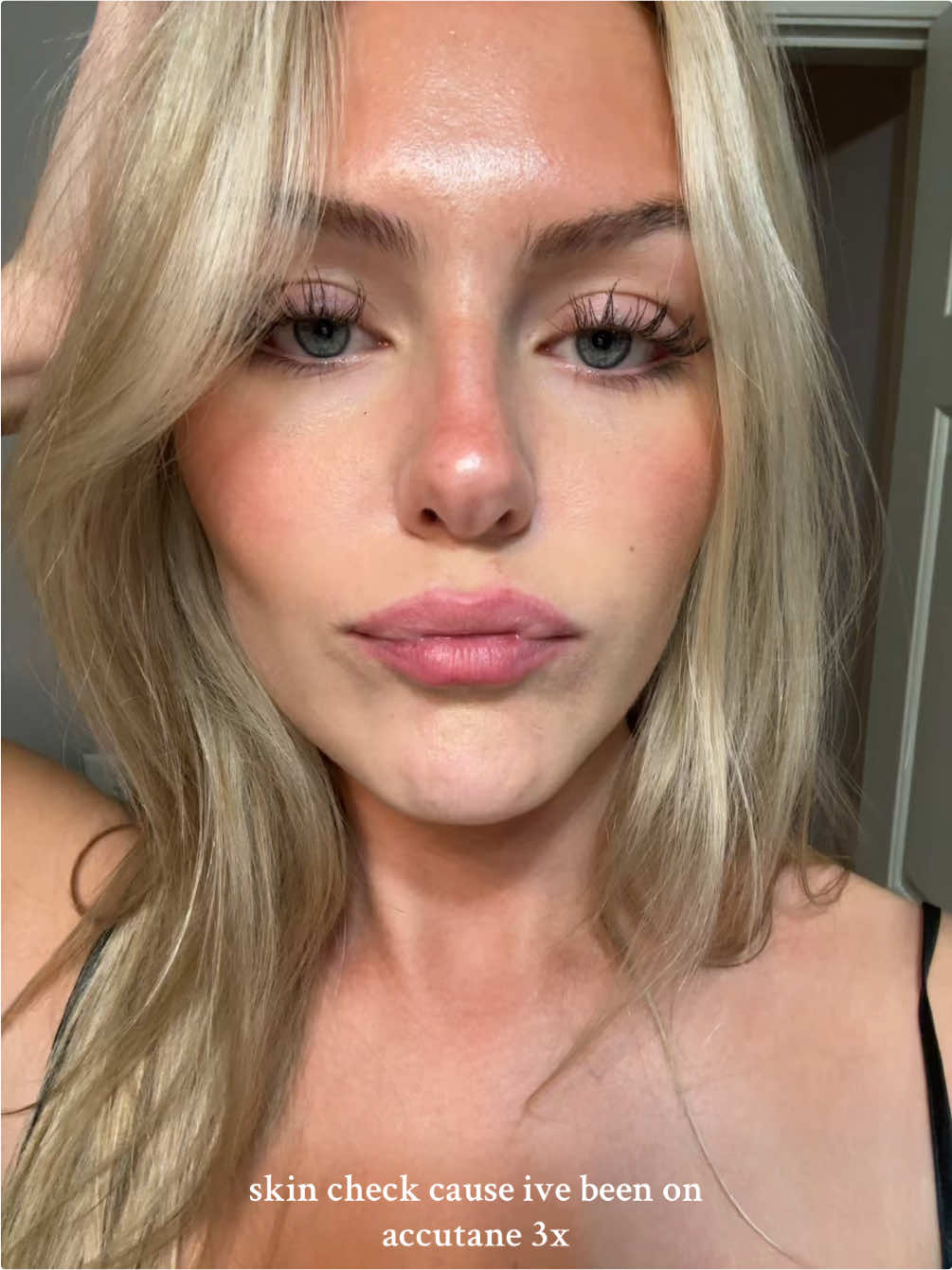 Im still wearing makeup but happy about the texture reduction <3 #accutane 