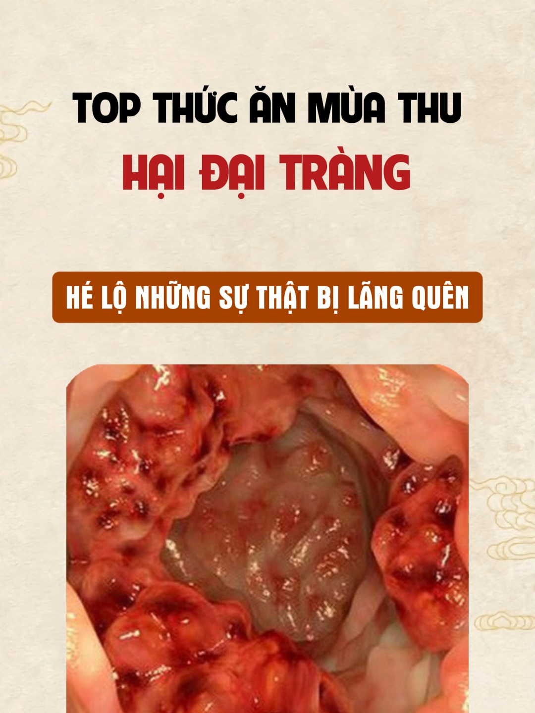 Mùa thu – đừng để đại tràng khô héo vì ăn sai thời tiết! Mùa thu đẹp, nhưng cũng là lúc đại tràng “kêu cứu” nhiều nhất! Thời tiết hanh khô khiến ruột mất ẩm, ăn quá nhiều đồ nướng, chiên, cay, nóng sẽ làm táo bón, đầy hơi, ngứa da. Hãy ăn đúng mùa – đúng tạng: rau củ chín mềm, bí đỏ, khoai, lê hấp mật ong, uống đủ nước ấm để dưỡng ẩm đại tràng – thông khí huyết – nhẹ bụng, khỏe da. #AnDungMuaThu #DaiTrang #TaoBonMuaThu #thuocdongygiatruyenpqa #suckhoe