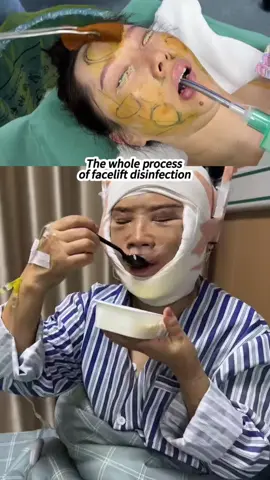 Sister who had a facelift is eating after surgery.#Facelift #拉皮 #NaturalFacelift 