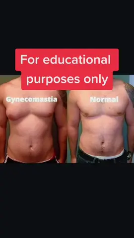 Male breast enlargement Man boobs Gynecomastia in men Male breast reduction Hormonal imbalance in men Gynecomastia treatment options Causes of gynecomastia #GynecomastiaAwareness  #MensHealthMatters  #MaleBreastReduction  #HormoneHealth  #ConfidenceRestored 