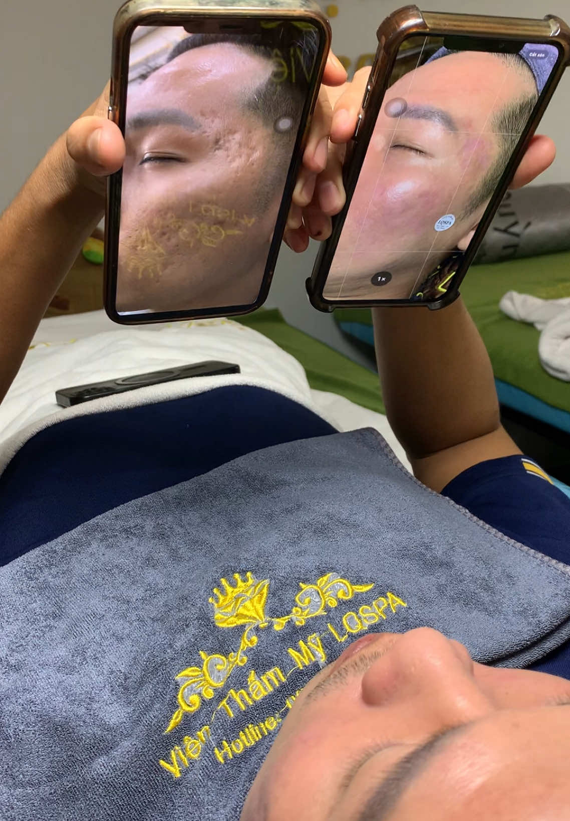 Thực tế da sẹo #chamsocdamun#chamsocdaseo#chamsocdanam#tanbinh#Lqspa 