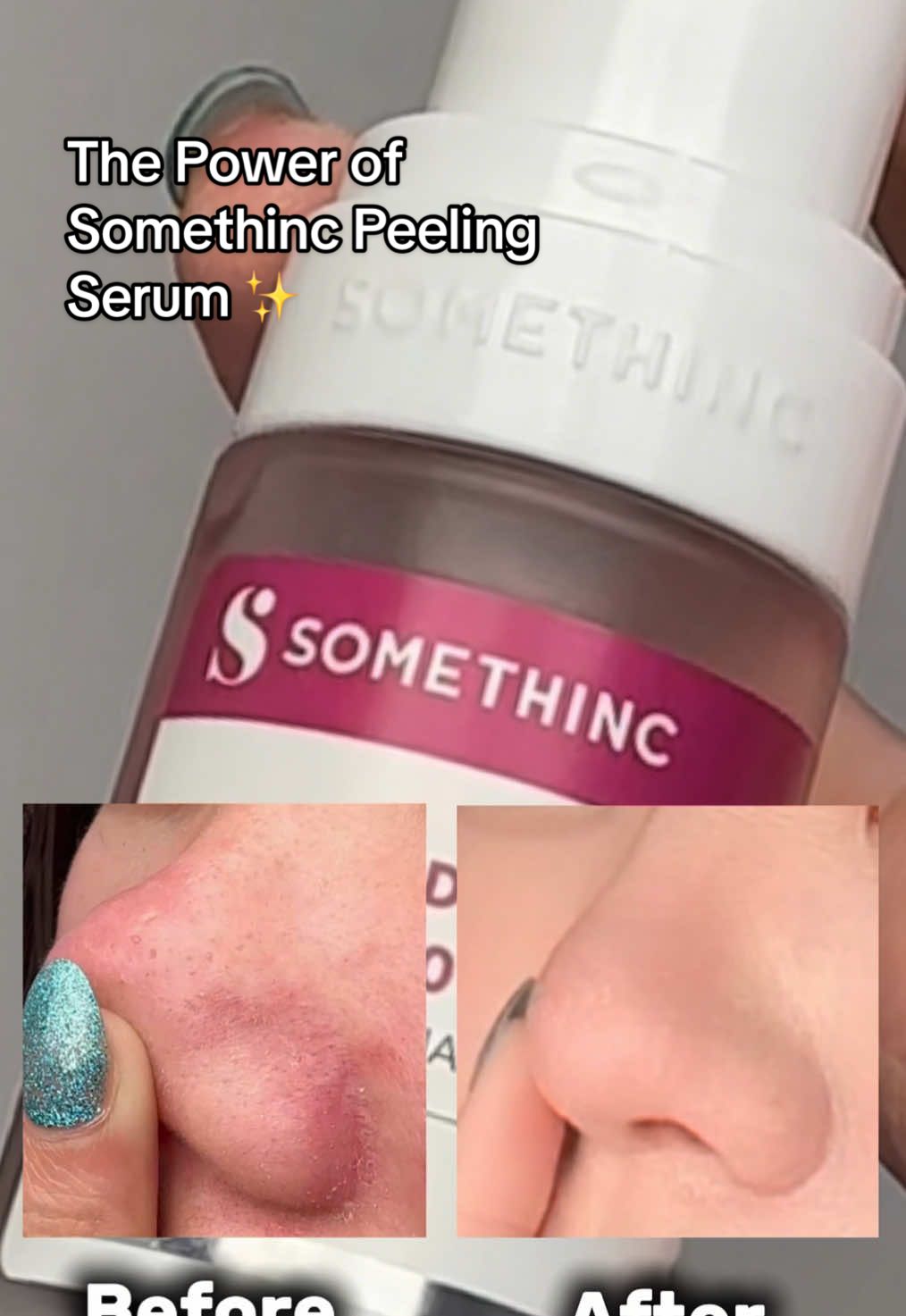 The Power of (NEW) #Somethinc Advanced Peeling Serum 🩸✨ #exfoliation #serumpeeling 