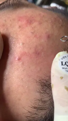 Ấn phát một #chamsocdamun#chamsocdaseo#chamsocdanam#tanbinh#Lqspa 