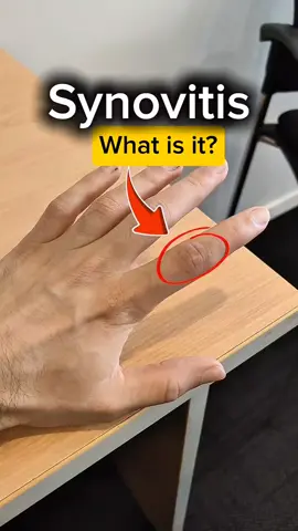 Stiff or achy fingers after climbing? It could be a sign of synovitis or capsulitis - irritation of the finger joint from overloading positions like full crimps or deep pockets. To help it settle: • Ease off higher-stress grips for now - focus on open-hand or easier climbs. • Apply ice after climbing to manage swelling or pain. • Do gentle range-of-motion exercises to keep the joint moving. • Prioritise recovery and gradual re-loading once symptoms improve. A short deload phase now can help you get back to stronger, pain-free climbing later.