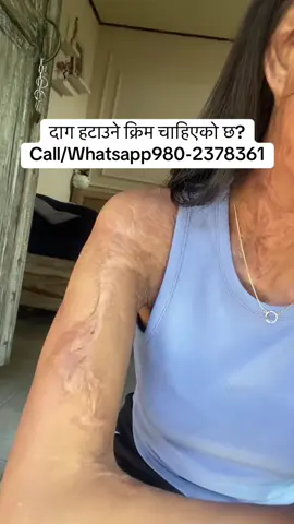 #muser #stretchmarks #stitch #burnt #scar 