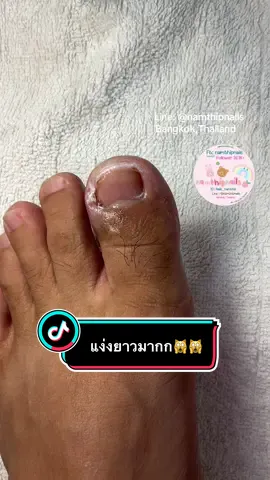 💓 #namthipnails #ตัดเล็บขบ #ตัดหนัง #ทำเล็บ #ร้านตัดเล็บขบ      Fb : namthipnails  Line : @namthipnails