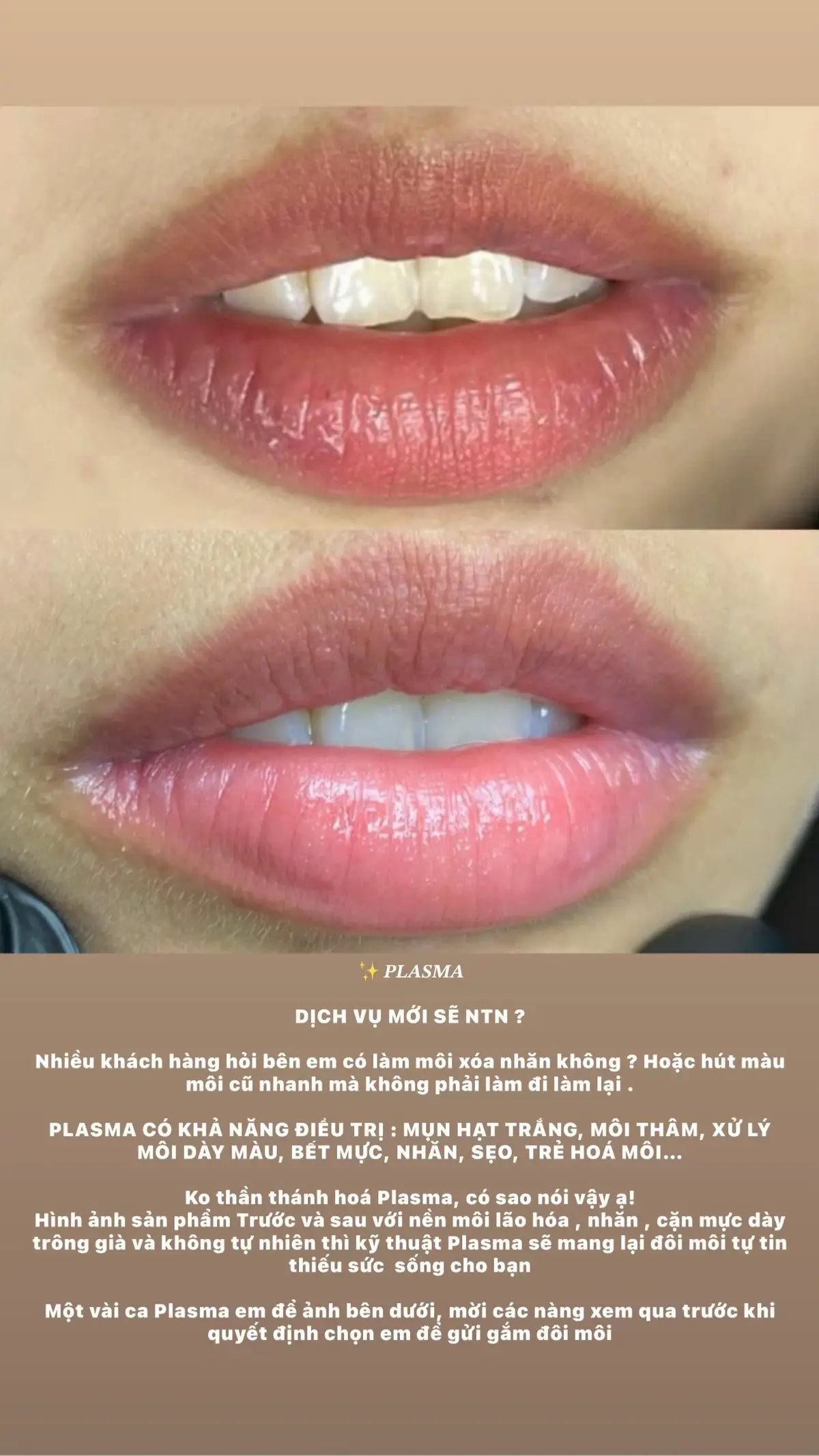 ✨𝑷𝑳𝑨𝑺𝑴𝑨  DỊCH VỤ MỚI SẼ NTN ? Nhiều khách hàng hỏi bên em có làm môi xóa nhăn không ? Hoặc hút màu môi cũ nhanh mà không phải làm đi làm lại . PLASMA CÓ KHẢ NĂNG ĐIỀU TRỊ : MỤN HẠT TRẮNG, MÔI THÂM, XỬ LÝ MÔI DÀY MÀU, BẾT MỰC, NHĂN, SẸO, TRẺ HOÁ MÔI… Ko thần thánh hoá Plasma, có sao nói vậy ạ! Hình ảnh sản phẩm Trước và sau với nền môi lão hóa , nhăn , cặn mực dày trông già và không tự nhiên thì kỹ thuật Plasma sẽ mang lại đôi môi tự tin thiếu sức  sống cho bạn  Một vài ca Plasma em để ảnh bên dưới, mời các nàng xem qua trước khi quyết định chọn em để gửi gắm đôi môi#phunxamphuquoc #khuthammoi #plasmatrehoamoi #phunmoidep 