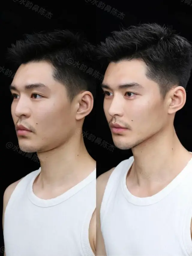 #鼻综合 #鼻整形 #nose #鼻子 #鼻修复 #rhinoplastie #nosejobs #隆鼻术 #rhinoplasty #隆鼻 #rhinoplastic #singapura #singapuratiktok #singapore #singapur #新加坡 #handsome #handsomeboy #handsomeman #handsomeguy #帅哥 #面部提升 #抗衰 #抗衰老 #拉皮 #face #facelift #facelifting #facelifts 