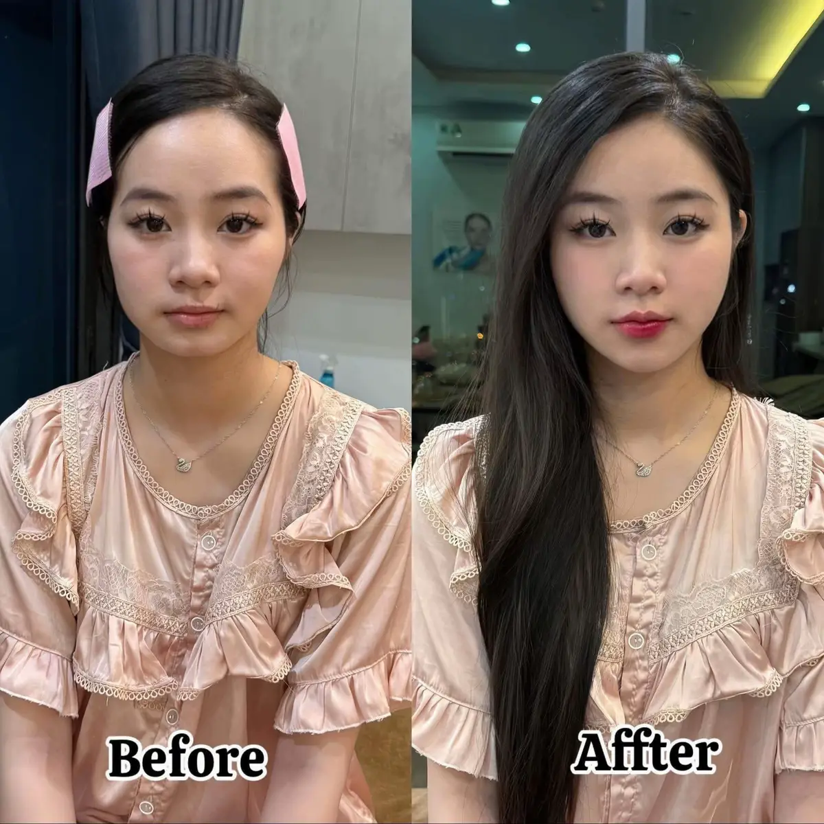 #tiemfillerhn #tiemfullface #minhhangfillerbotox #tiemfillerhanoi 