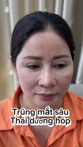Trũng mắt sâu và thái dương hóp mấy bà không biết làm gì ,thì mời mấy bà di chuyển vào video này đi👇😂@HỌC VIỆN CHIANG MIE @Chiang mie Điêu khắc mỹ nhân #tanmonong #filler #boxtox #cânchinhfullface 