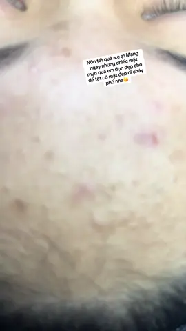 Sắp tết rồi phải không ạ?😂 Ngày nào cũng ăn ngủ với mụn mới chịu #TikTokAwardsVN #nặnmunbangtay 