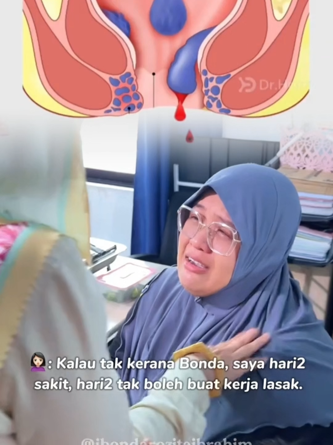 Buasir boleh diubati tanpa pembedahan. Buasir mengecut#buasir #buasirluar #buasirtiadalagi #buasirdalam