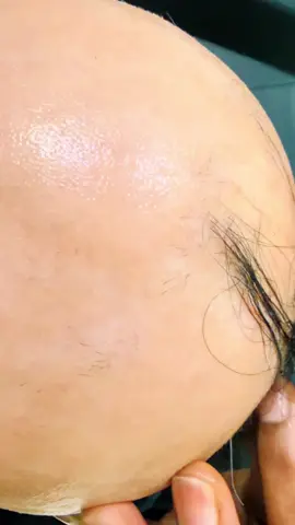 #الشعب_الصيني_ماله_حل😂😂 #trandyhair #تساقط_شعر #انباث_الفراغات #خلايا_جذعية 