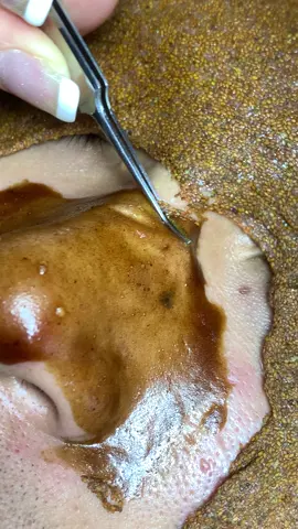 Nhiều #chamsocdamun#chamsocdaseo#chamsocdanam#tanbinh#Lqspa&academy 