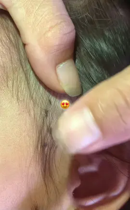 #tiktok_india #removalice #lice #omg 