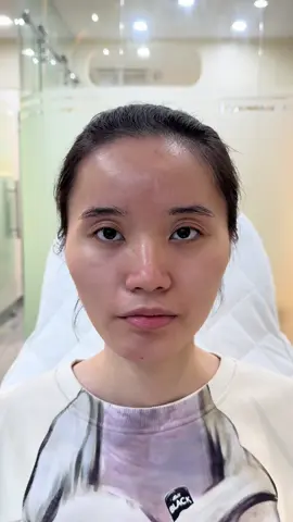 Cải thiện má, thái dương hóp do niềng răng siêu tự nhiên với 5cc  #lamdep #fillerbotox #botoxgonham #tiemmoi #tiemfiiler 