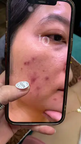 Cập nhật da mụn thâm #chamsocdamun#chamsocdaseo#chamsocdanam#tanbinh#Lqspa&academy