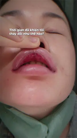 Gu ai môi mỏng thích hở răng thỏ như tuuii không ạ 😘😘😘 thành công ưng quá trời ❤️❤️❤️#pttm #cắtmoi #môibaby #cắtmôidày  #CapCut 