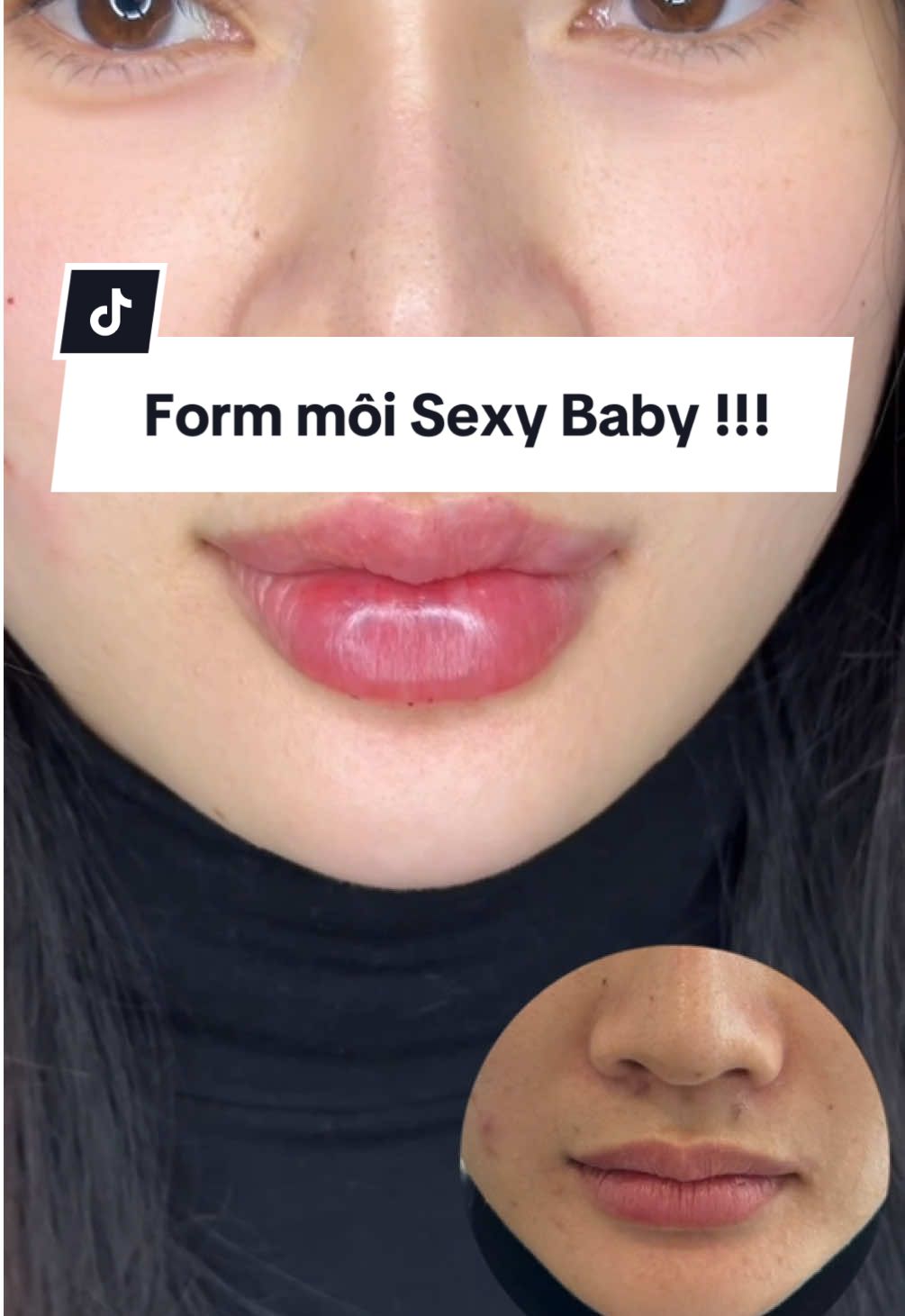 Form môi siêu xinh cho các nàng thích nhẹ nhàng #maimaifiller #tiemmoi #xuhuong 