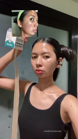 แปะละไปนอนนนน #แผ่นแปะซิลิโคนเจล #แผ่นแปะซิลิโคน #ส้มโอที่หน้าเป็นสิว #ใช้ดีบอกต่อ #ป้ายยาtiktok 