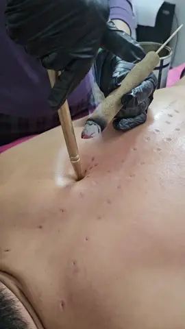 cứu ngải sao cho đúng #ĐôngY #huyềnchâm #câyđồng #ThiênBáchThủ #dưỡngsinhđôngy 