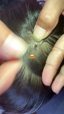 #tiktok_india #removalice #lice #omg 