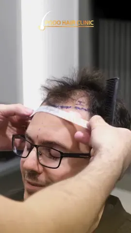 Every detail counts — from the first marking to the final result ✨ At Podo Hair Clinic Germany, we combine artistry and medical precision to design the perfect hairline for every patient. #HairRestoration #PodoHairClinic #HairTransplantExperts #FUEGermany #NaturalDensity  