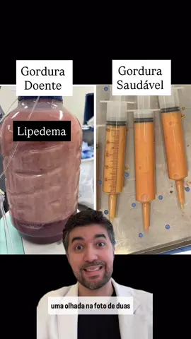 #lipedema #cirurgiadelipedema #tratamentodelipedema #saudelinfatica #doresnaspernas
