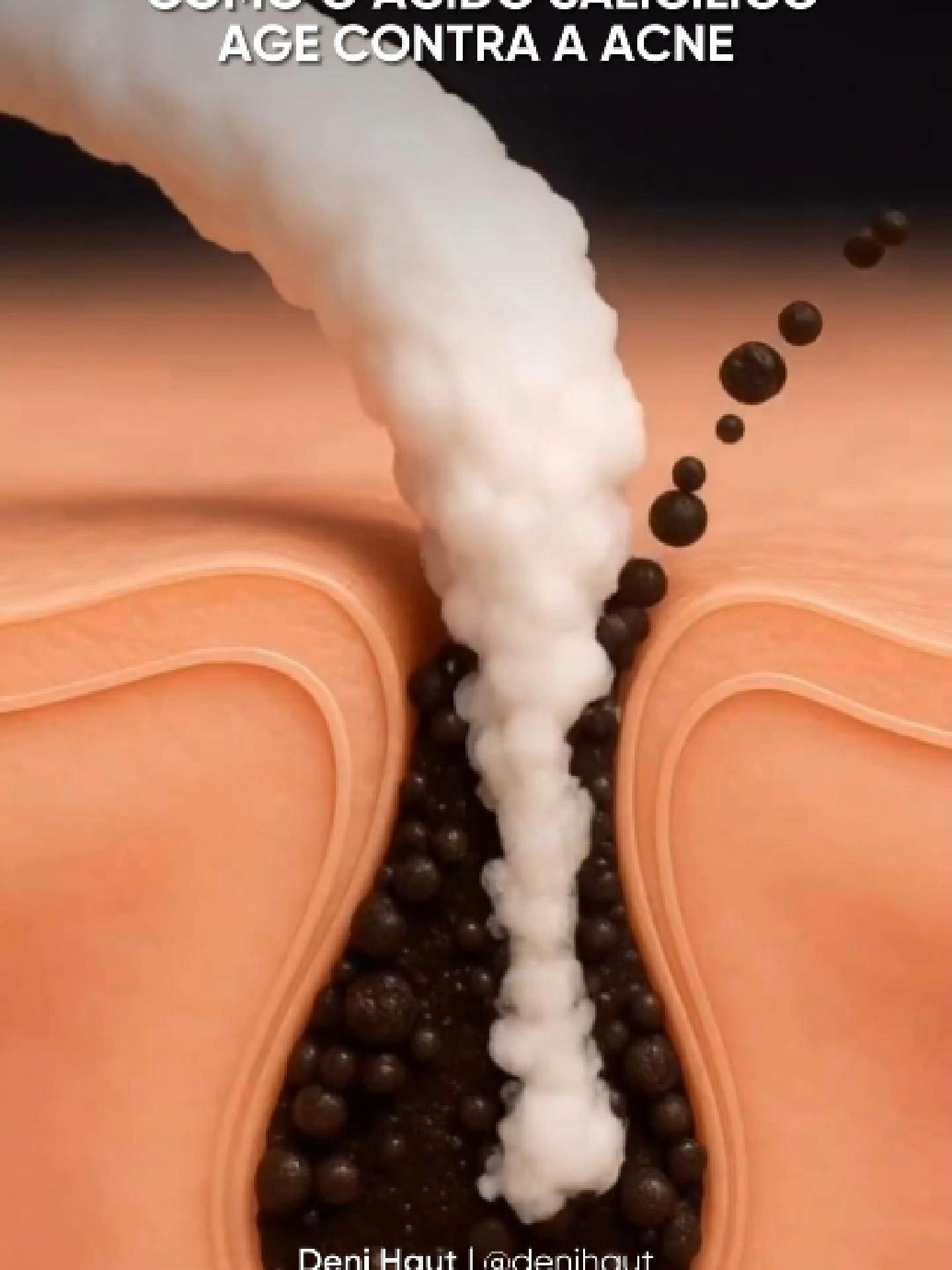 O Ácido Salicílico é um dos grandes aliados no combate à acne, graças à sua ação multifuncional sobre os três principais fatores que a provocam: poros obstruídos, produção excessiva de sebo e inflamação. Ele atua de dentro para fora, desobstruindo os poros, regulando a oleosidade e acalmando a inflamação, tornando-se uma escolha inteligente para quem busca tratar acne de maneira eficaz e com suporte científico. A minha indicação vai para o Salycilic Control, um sérum leve e ideal para pele acneica com Ácido Salicílico e mais 5 ativos anti-inflamatórios e sacativos. ❗Aproveite 40% OFF na Black November da Skin Therapy!