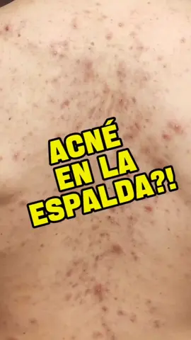 Tenés acné en la espalda? Te cuento cómo solucionarlo 🤔➡️ . . . . . #acne #espalda #bacne #dermatologia #skincare