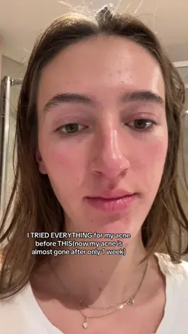 The progress is insane🥹 #nollaacne #clearskin #acnetreatment #skincare #skintok 