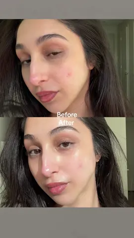 Try a non pore clogging moisturizer!! Love this purito mighty bamboo panthenol cream bc it hydrates your skin AND brightens over time- this is why I love Korean skincare! @PURITO SEOUL #purito #panthenolcream  #blemishout #FadeAcneMark  #realpostacnecream  