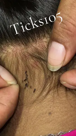 Remove lice #😱😱😱omg #😭😭😭 #😂😂😂 #liceremoval #🥶🥶🥶 
