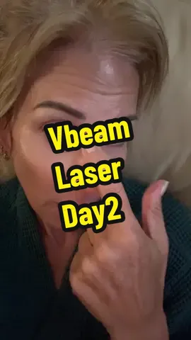 Seems to be fading. Hope it goes all the way away #dermatologist #skincare #vbeam 