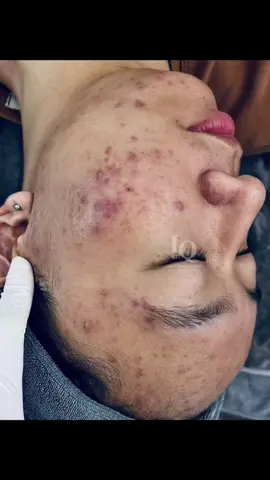 Cập nhập da #chamsocdamun#chamsocdaseo#chamsocdanam#tanbinh#Lqspa&academy