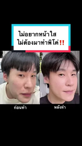 ท่านประธานบิ๊ก หน้าใสเหมือนอปป้าเพราะทำสิ่งนี้ที่ออร่านี่เอง⁉️ #ท่านประธานบิ๊ก #บิ๊กอชิรพล #อีลูกช่างสอดพิโค่เลเซอร์ #picomajesty #หน้าใส #รูขุมขนกว้าง #รูขุมขนกระชับ #พิโค่ #ชาอึนอู #รีวิวหัตถการที่ทํา #รีวิวคลีนิค #รีวิวบิ้วตี้ 