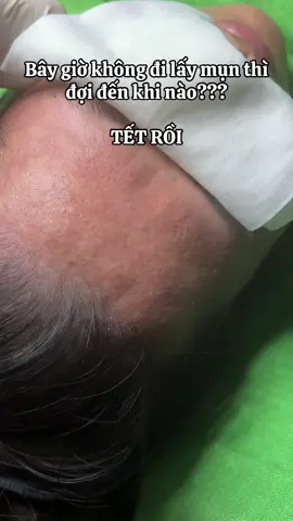 Đợi khi nào lấy mụn #nhienspaq12 #duocmypham #trimunchuanykhoa 