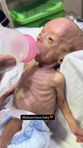 A memorable click from one of our precious baby😢💔 #NicuBaby #malnutrition #prematurebaby #drnadeem804 