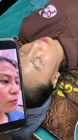 Cập nhật da mụn thâm sạm Mệt #chamsocdamun#chamsocdaseo#chamsocdanam#tanbinh#Lqspa&academy