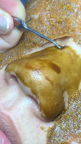 Kéo #chamsocdamun#chamsocdaseo#chamsocdanam#tanbinh#Lqspa&academy&academy  