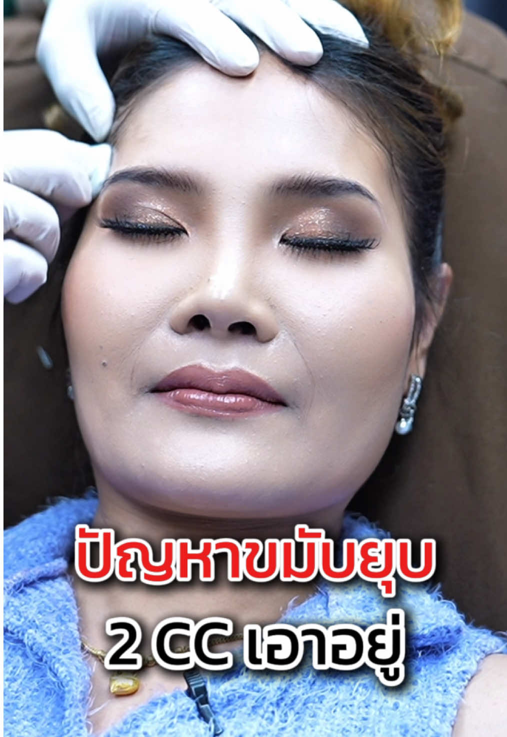 ปัญหาขมับยุบ 2 Cc เอาอยู่!! #dsc #กระแสมาแรง #fillers💉