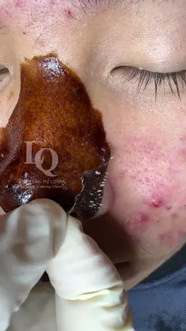 Đã  #chamsocdamun#chamsocdaseo#chamsocdanam#tanbinh#Lqspa&academy