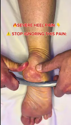 ⚠️ STOP IGNORING THIS PAIN: If your heel feels like you’re walking on a knife, especially first thing in the morning… this is for you. This isn’t just “heel pain.” This is fascia tearing and your Achilles + foot arch pulling against each other. When the fascia under the foot becomes tight + inflamed, your body compensates: • Heel starts burning / stabbing • Calf becomes stone hard • Achilles loses elasticity • Knee + hip alignment shifts • Lower back starts reacting This release technique restores the blood flow and glide that your heel lost. Once the fascia is free → the pain finally stops. ✅ Better mobility ✅ Less morning pain ✅ Better arch support ✅ Faster recovery ✅ Stronger gait Your foot is not broken. It’s stuck. Save this. Do this. Your heel will thank you. 👣🔥 #plantarfasciitis #heelpain #footpain #footpainrelief 