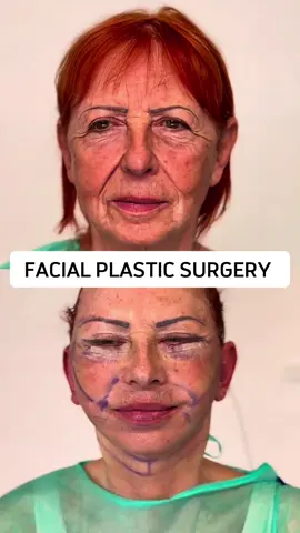 My Chinese three-point facial lift is a plastic surgery technique that completely improves facial sagging and wrinkles through surgical or non-surgical methods. The principle mainly includes the following aspects: 1. Enhancement of SMAS layer: The SMAS layer is a layer of connective tissue between the facial skin and muscles. By enhancing the SMAS layer, facial skin can be tightened, reducing wrinkles and sagging. 2. Ligament elevation: There are many ligaments on the face that connect the facial bones and muscles. By lifting these ligaments, the facial support structure can be enhanced and sagging can be reduced. 3. Fat reset: The distribution and location of facial fat can also affect the appearance of the face. By adjusting the position and distribution of fat, facial contours and lines can be improved The surgical process takes only 20 minutes to recover, and the recovery period can last for 2-3 days Sustainable results 8-12 years #整形 #抗衰老 #医美 #变美 #面部提升 