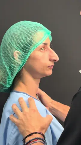 Jessica es una deportista de élite que llevaba muchos  años deseando hacerse su rinoplastia ultrasonica sin cicatrices. Aquí tenemos el resultado inmediato.. Hay mucha piel que tendrá que adaptarse,pero ya podemos observar una nariz más armonica y natural  ¿Qué os parece este resultado? Os leemos 👀 #rinoplastiaultrasonica #mejorsincicatriz #thesmartguidetorhinoplasty #rinoplastia #Rinoplastia 