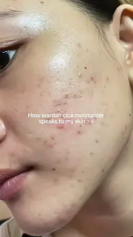 ‼️read caption‼️⠀⠀⠀⠀⠀⠀⠀⠀⠀⠀⠀⠀⠀⠀⠀⠀⠀⠀⠀⠀⠀⠀⠀⠀⠀⠀⠀⠀⠀⠀⠀⠀⠀⠀⠀⠀⠀⠀⠀⠀⠀⠀⠀⠀⠀ ini asli ngaruh buat kemerahan sama jerawat