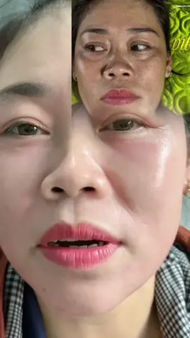 Peel giúp “đẹp nhanh”, còn dưỡng giúp “đẹp bền”. Cả hai kết hợp đúng cách mới thật sự giúp da đẹp khỏe. #peelda #trinam #tinhchathutsachsactoda 