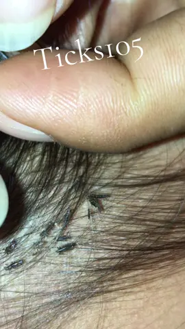 Remove lice #😱😱😱omg #😭😭😭 #😂😂😂 #liceremoval #🥶🥶🥶 