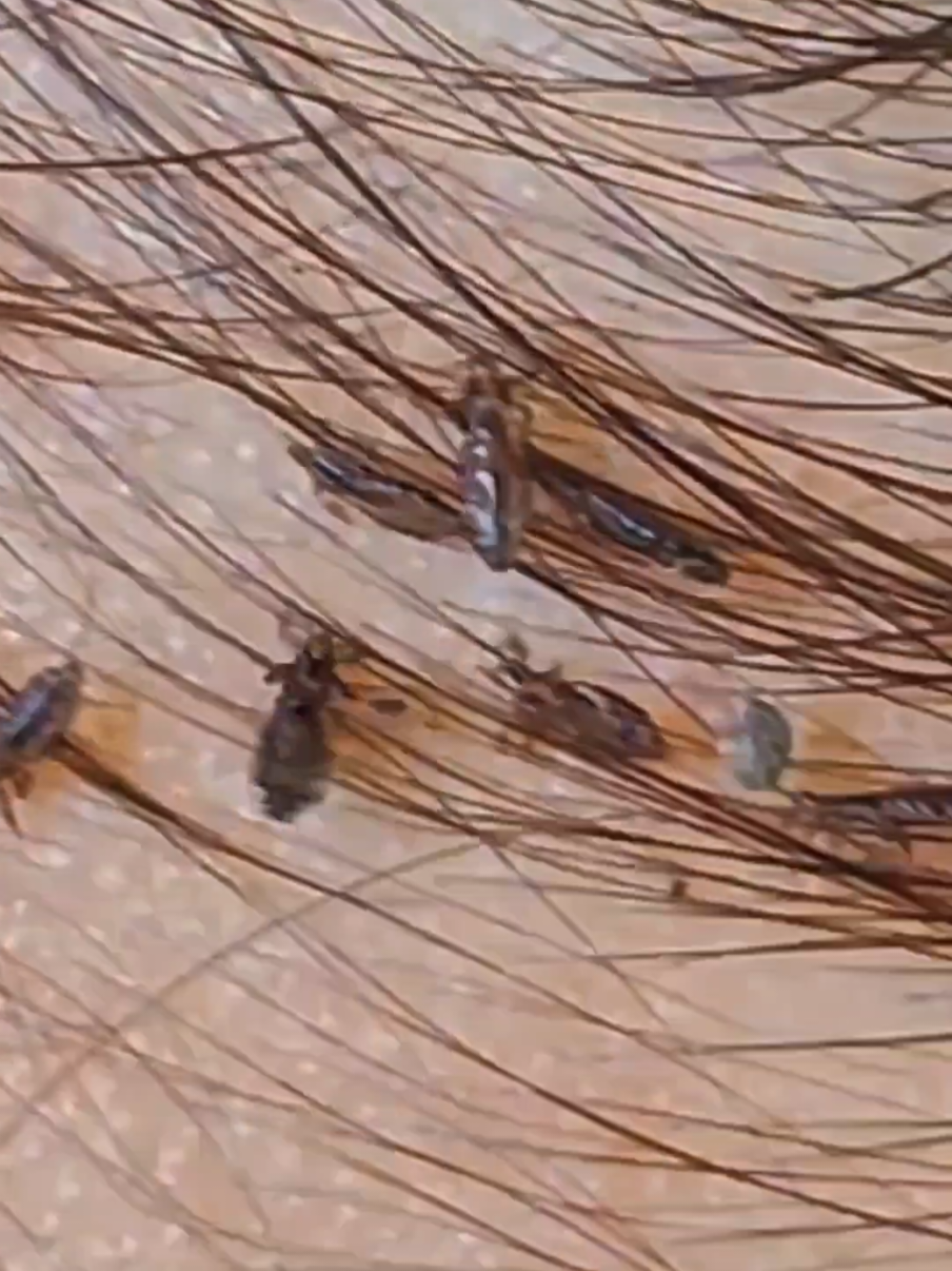 Find Lice 175 #omg #lice #tripofobia #liceremoval #licetreatment 