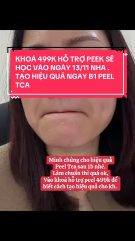 Ai bảo peel 1b ko cải thiện? Bạn peel tca 1b trả da đẹp ntn kh chốt luôn cả gói nha. KHOÁ 499K HỖ TRỢ PEEK SẼ HỌC VÀO NGÀY 13/11 NHA . #peeltca #daypeeldakhoahoc #hocpeelda #xuhuong #daotaospa 